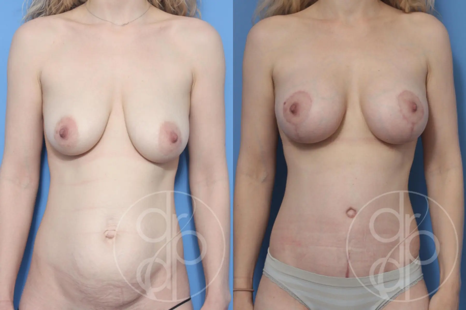 Mommy Makeover: Patient 2 - Before and After  