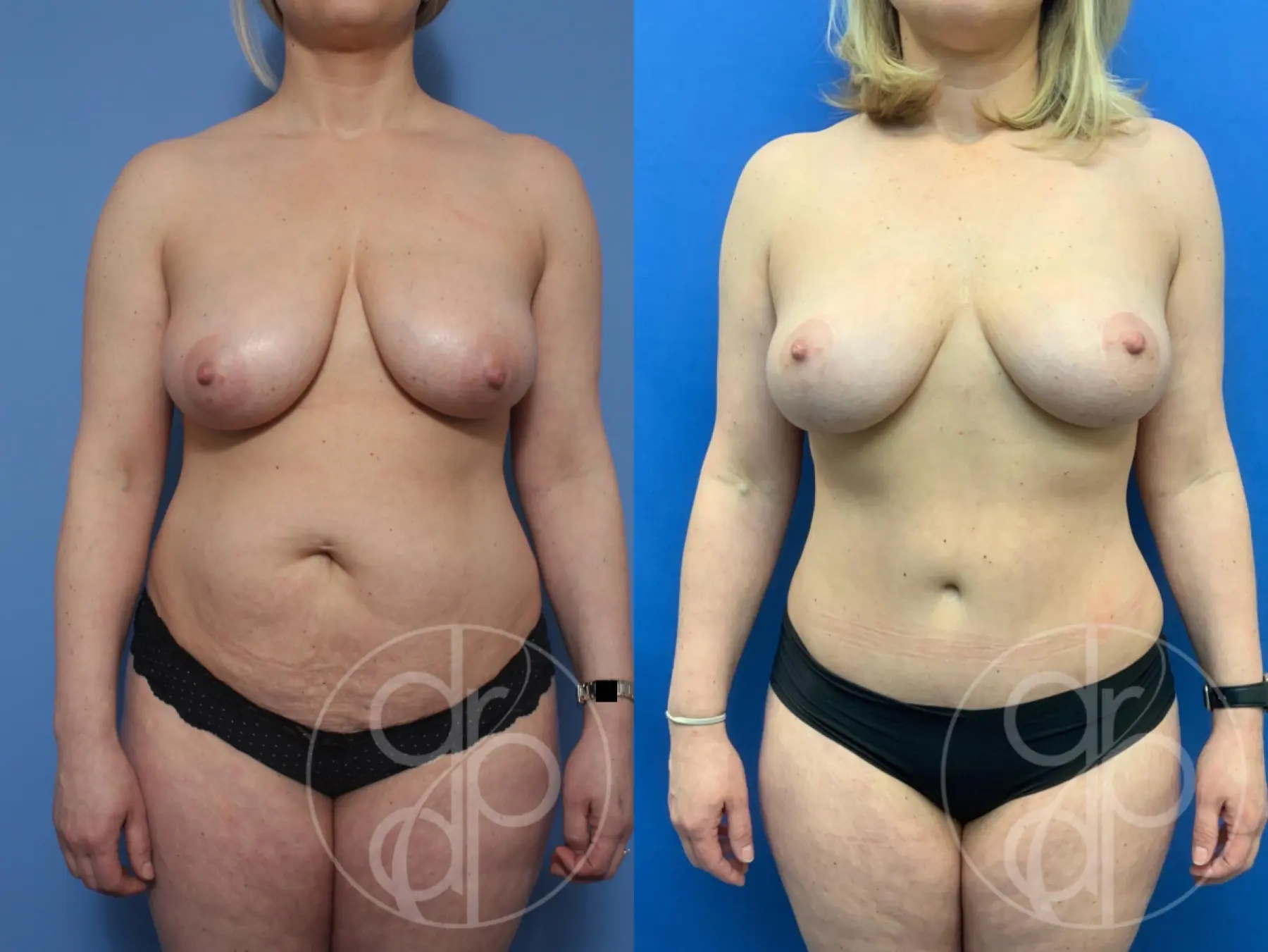 patient 10336 mommy makeover before and after result - Before and After 1