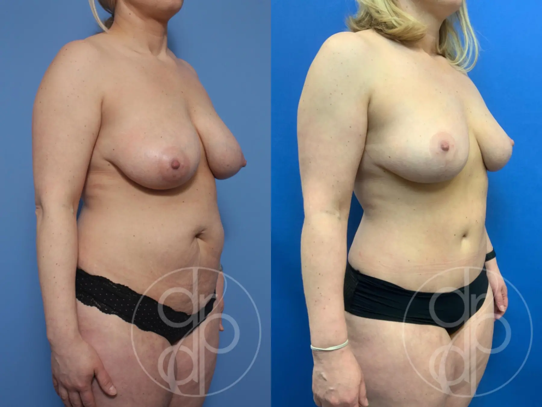 patient 10336 mommy makeover before and after result - Before and After 2