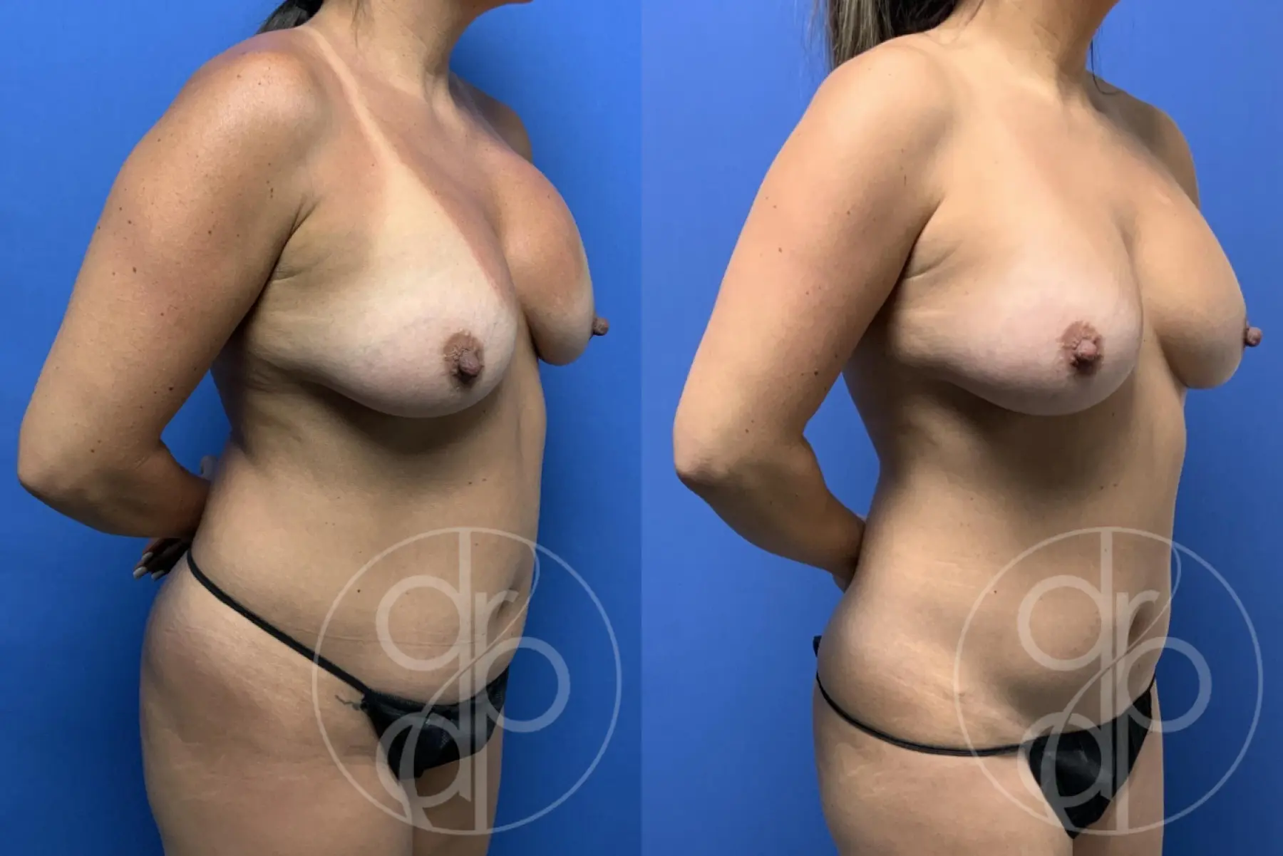 patient 13385 mommy makeover before and after result - Before and After 3