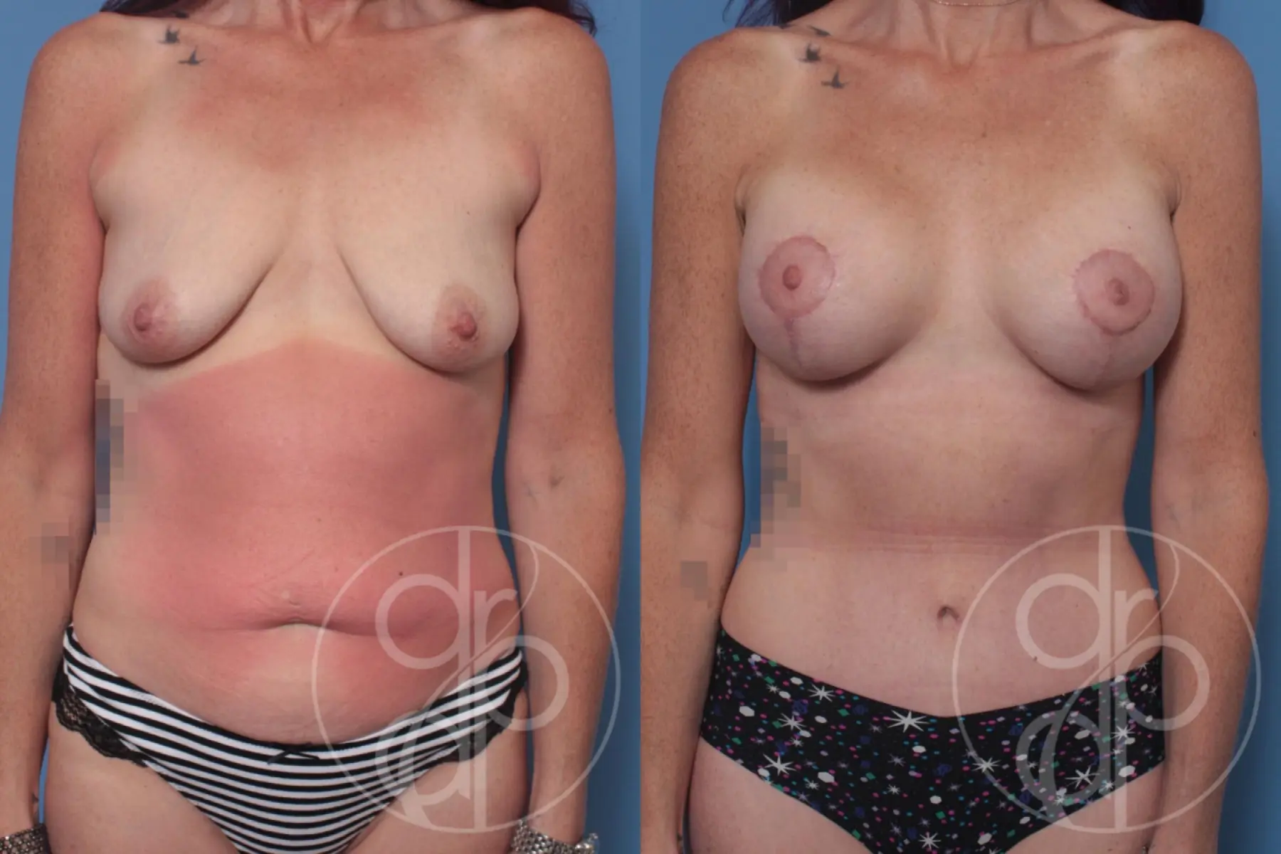 patient 10190 mommy makeover before and after result - Before and After 1