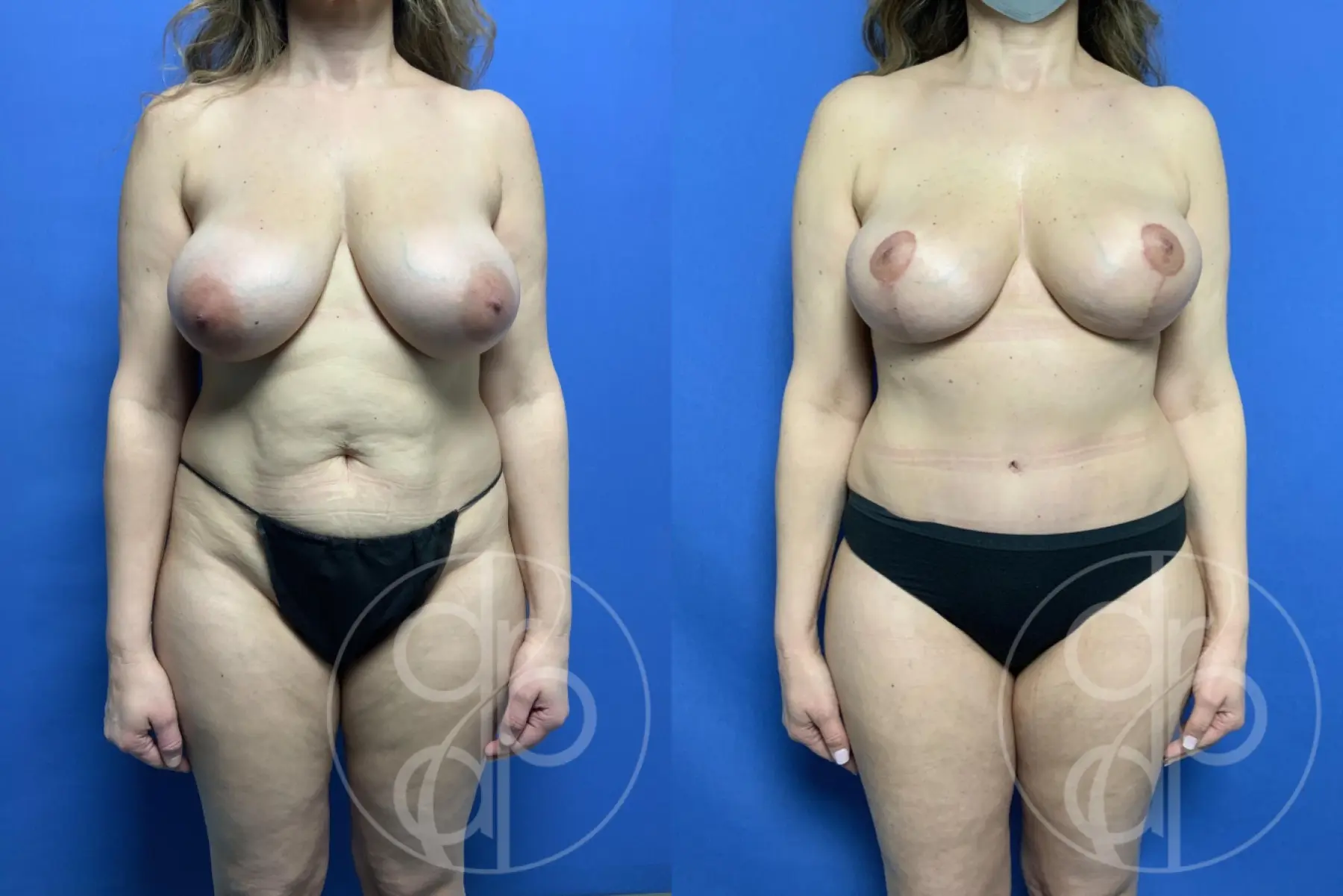 patient 13434 mommy makeover before and after result - Before and After 1