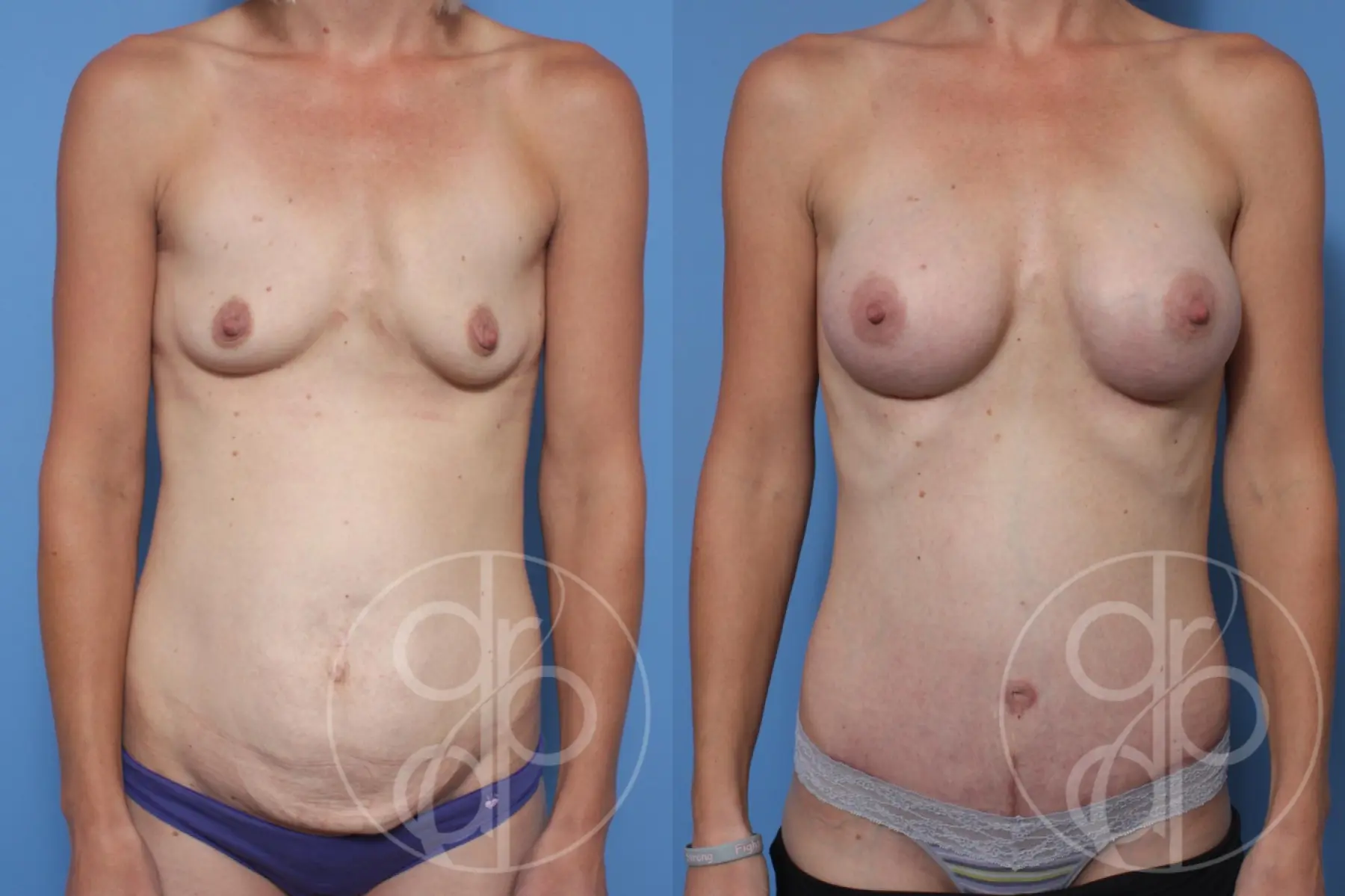 Mommy Makeover: Patient 9 - Before and After  