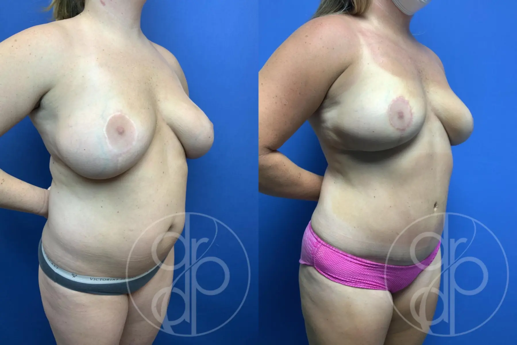 patient 10771 mommy makeover before and after result - Before and After 2