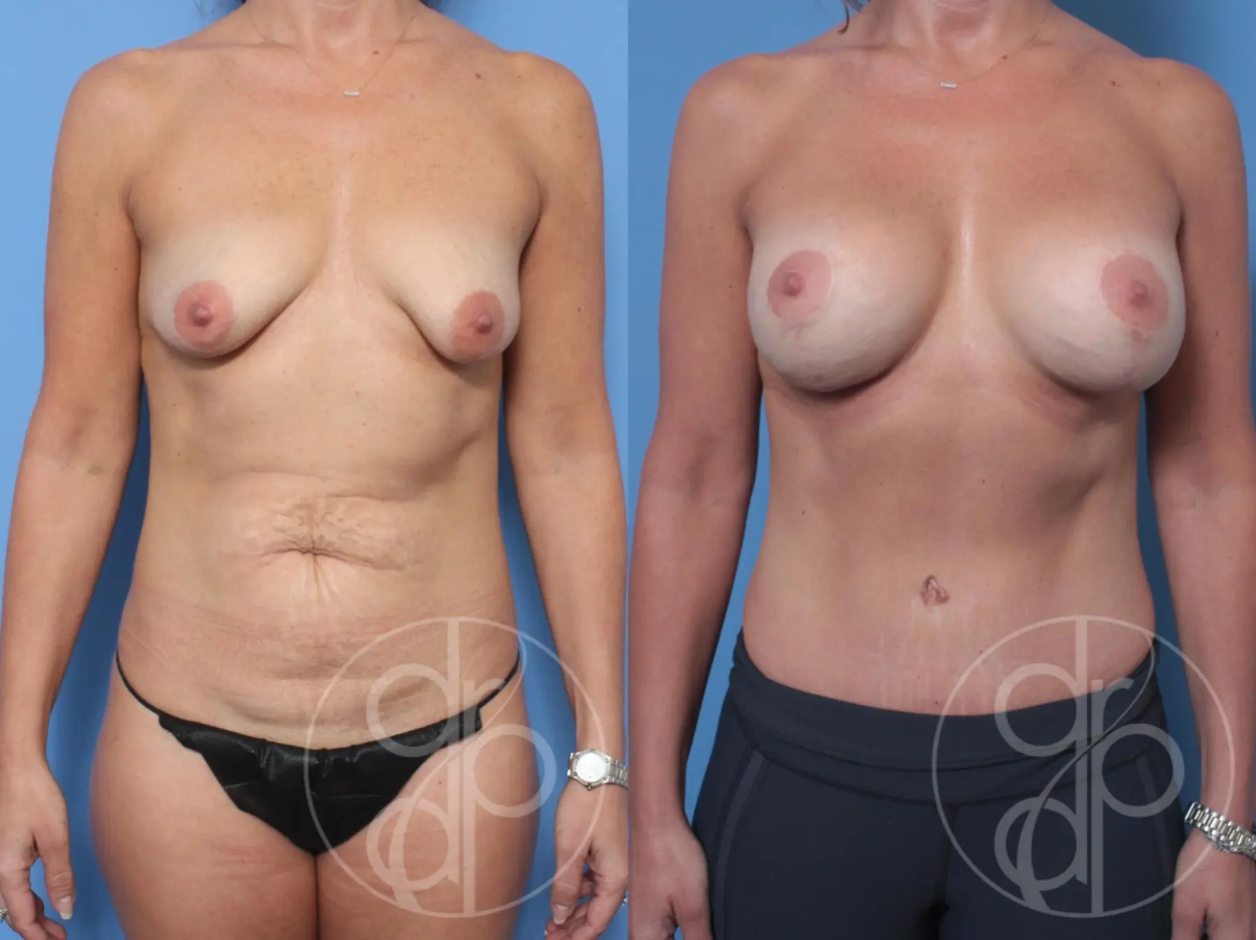 Mommy Makeover: Patient 8 - Before and After  