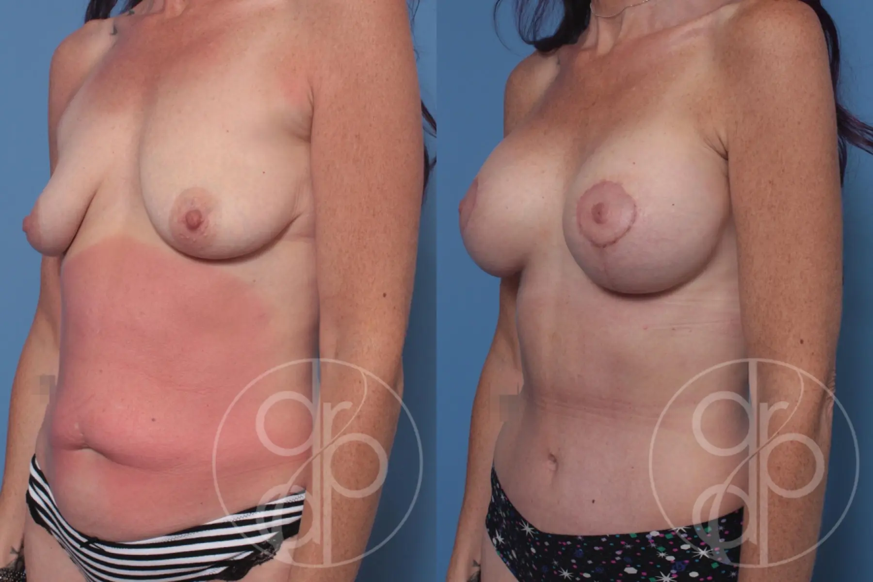 patient 10190 mommy makeover before and after result - Before and After 3