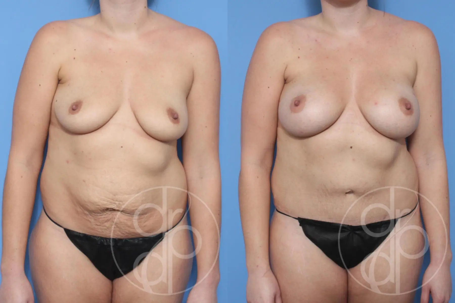 Mommy Makeover: Patient 1 - Before and After  