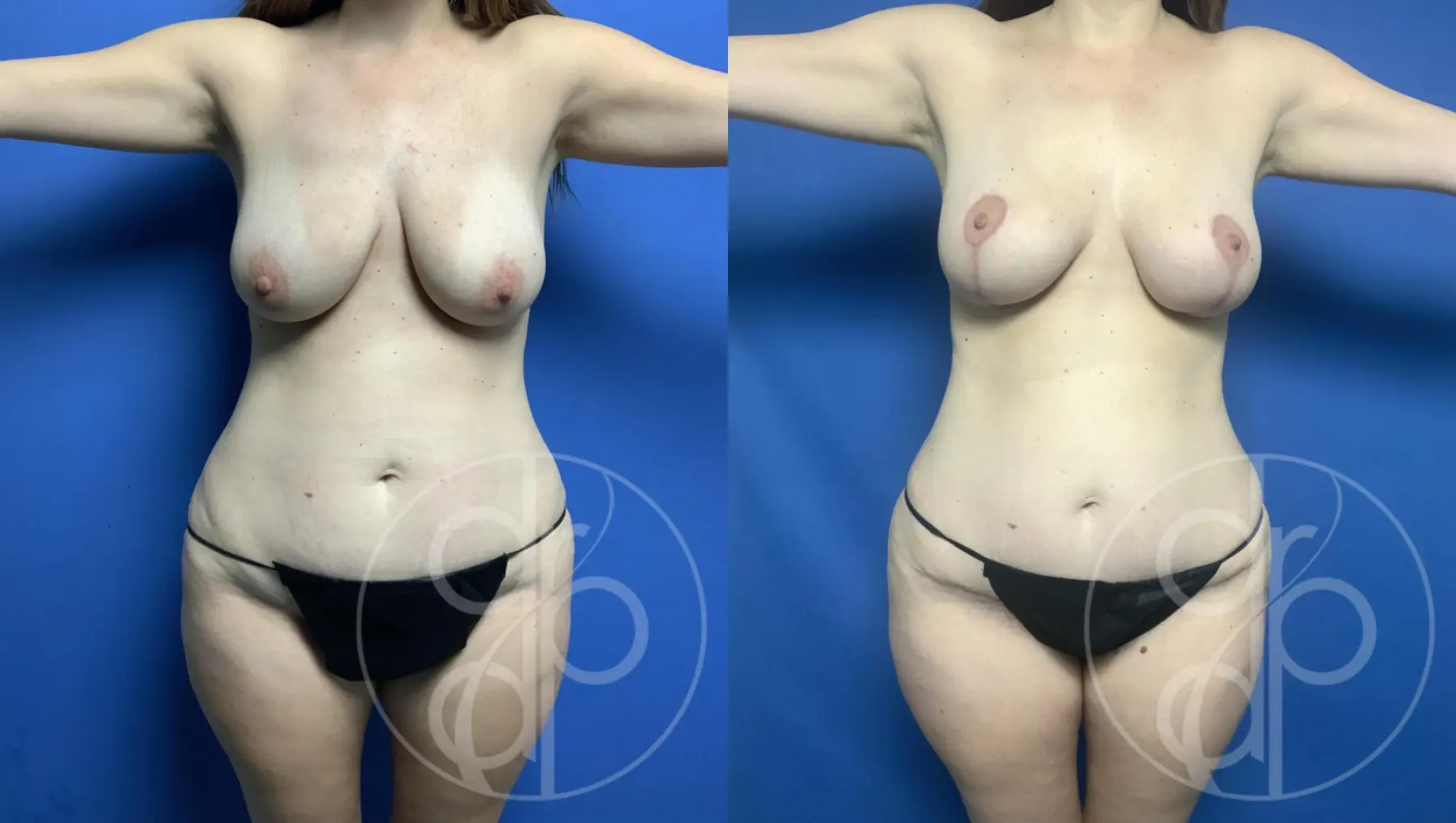 Mommy Makeover: Patient 2 - Before and After  
