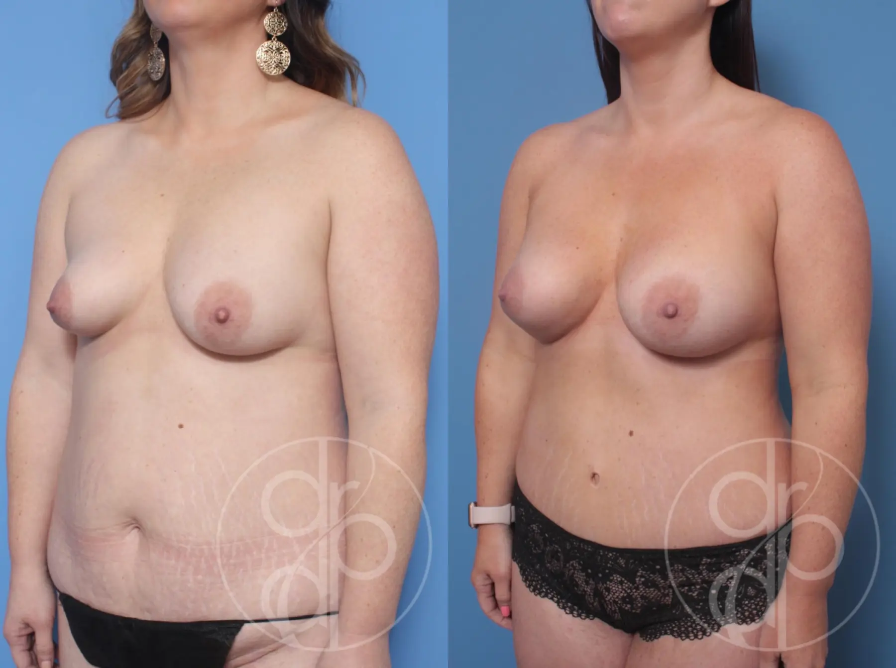 patient 10246 mommy makeover before and after result - Before and After 3