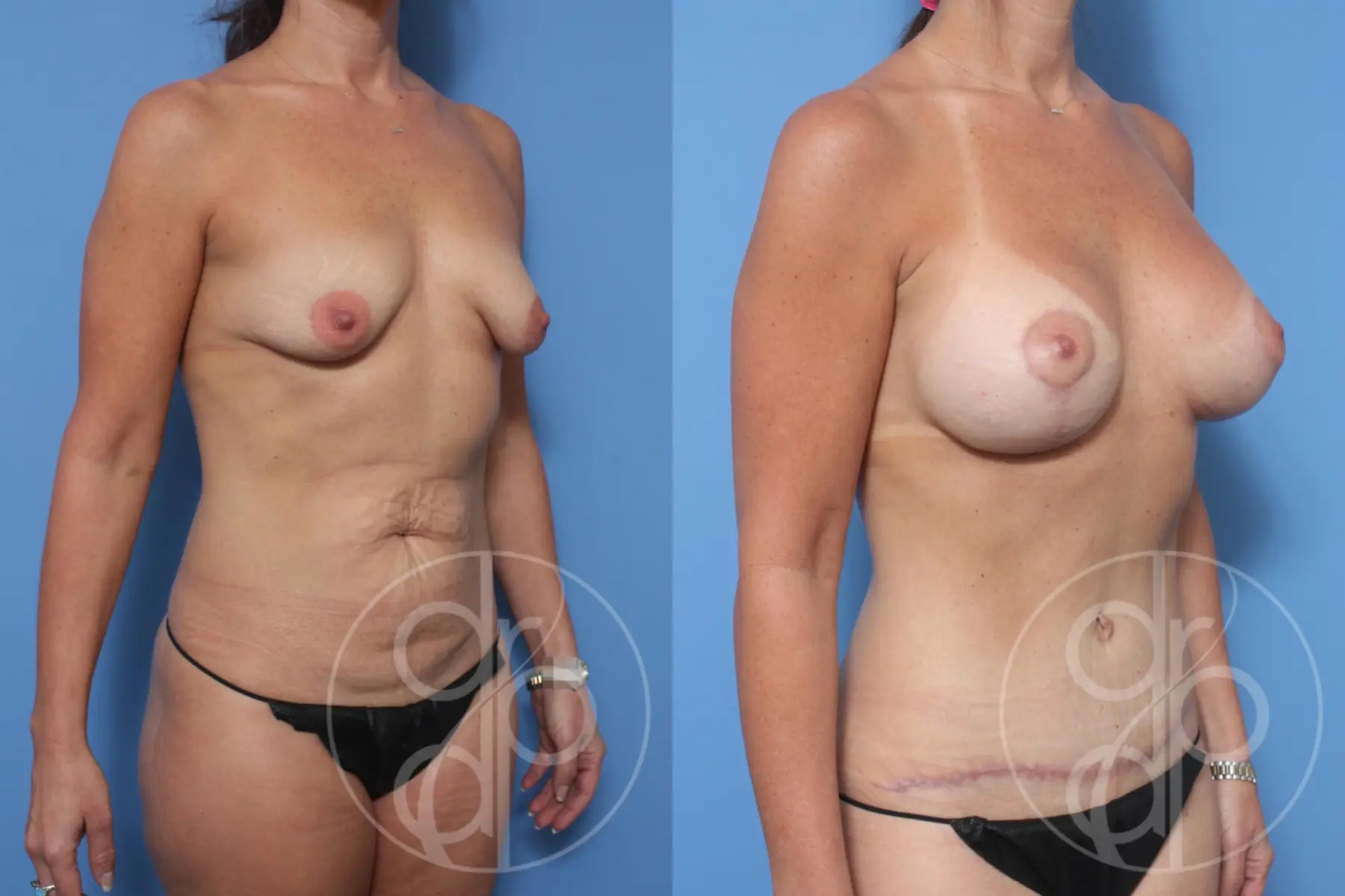patient 10280 mommy makeover before and after result - Before and After 3