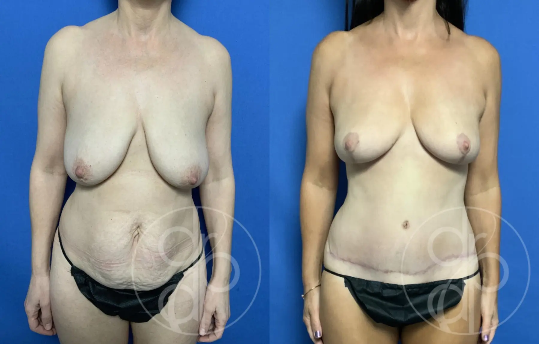 patient 12773 mommy makeover before and after result - Before and After 3