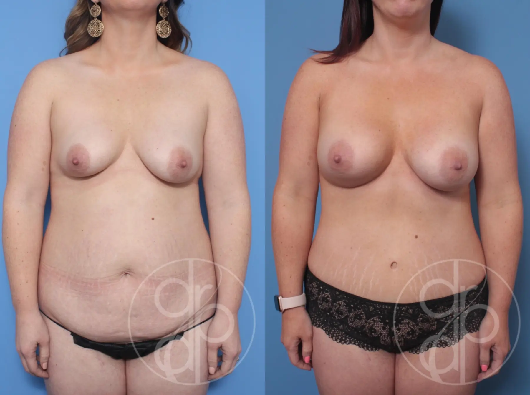patient 10246 mommy makeover before and after result - Before and After