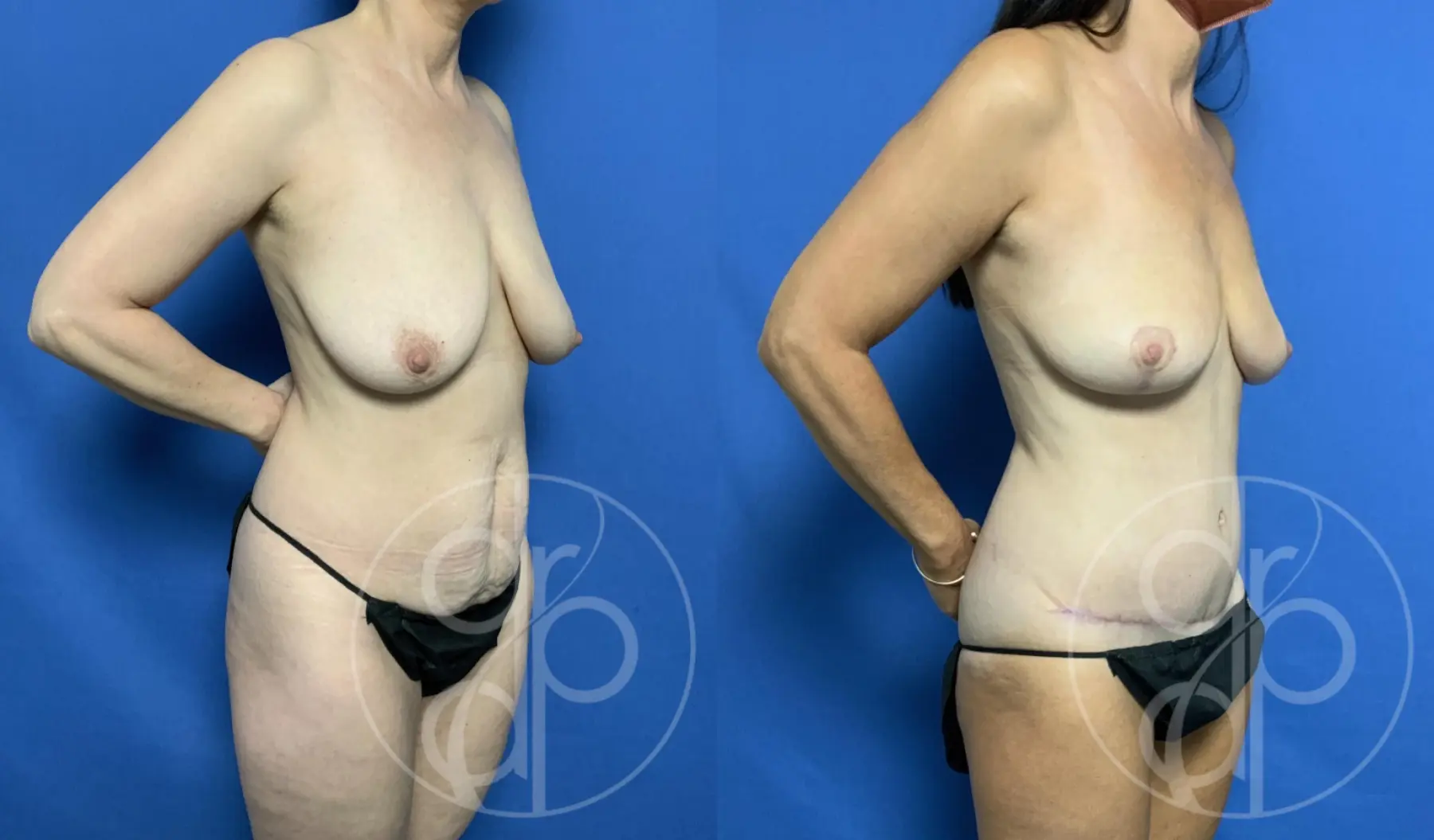 patient 12773 mommy makeover before and after result - Before and After 1