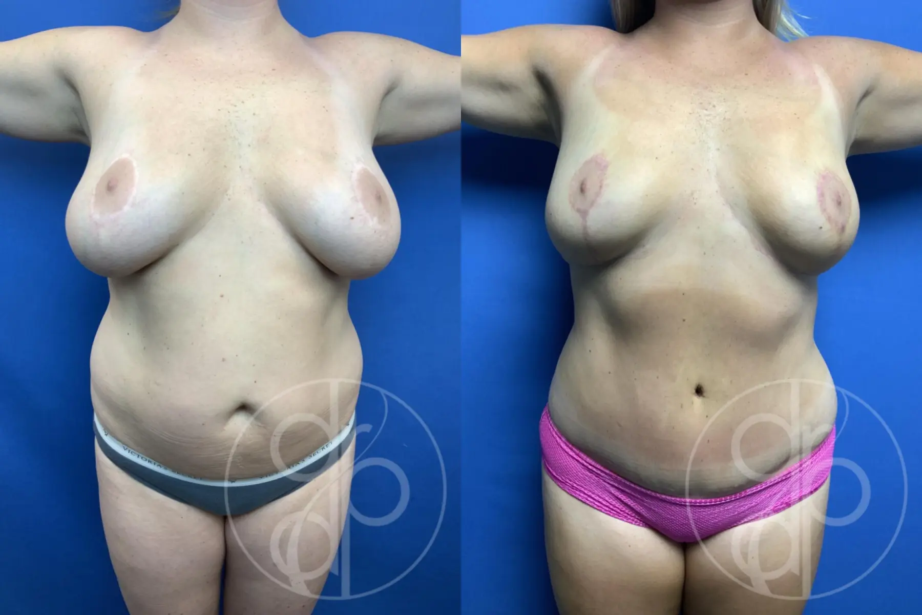 patient 10771 mommy makeover before and after result - Before and After 1