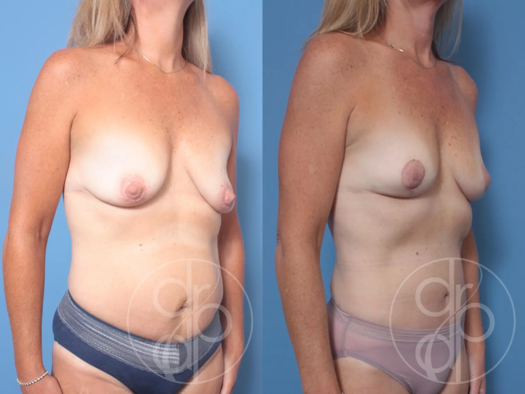 patient 10149 mommy makeover before and after result - Before and After 2