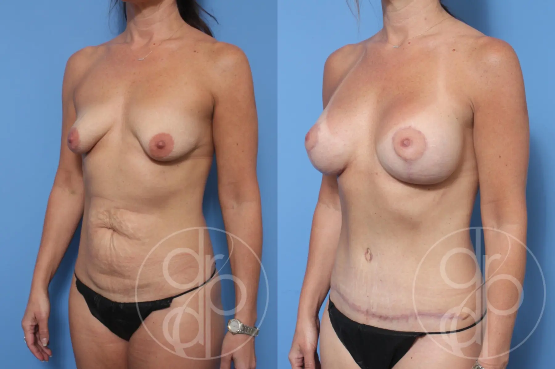 patient 10280 mommy makeover before and after result - Before and After 2