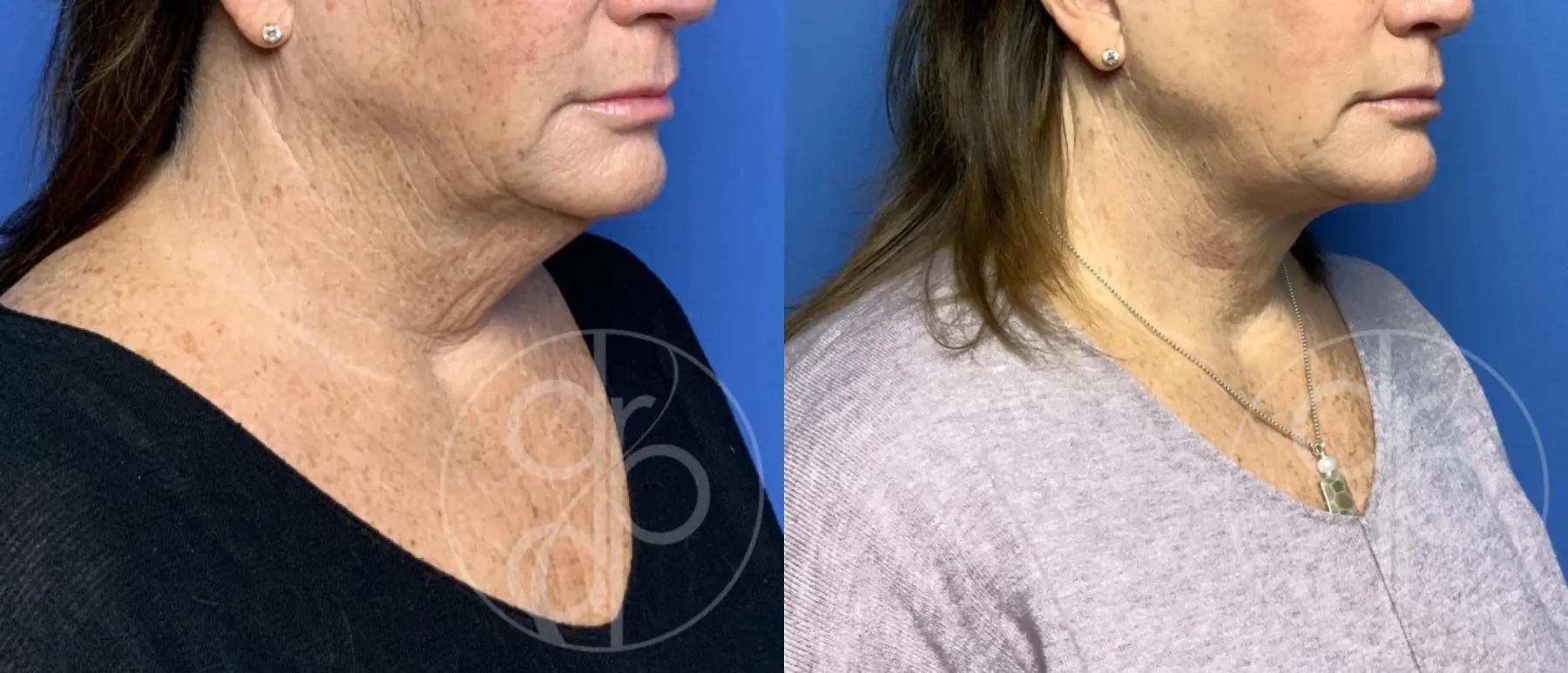 patient 11909 neck lift before and after result - Before and After