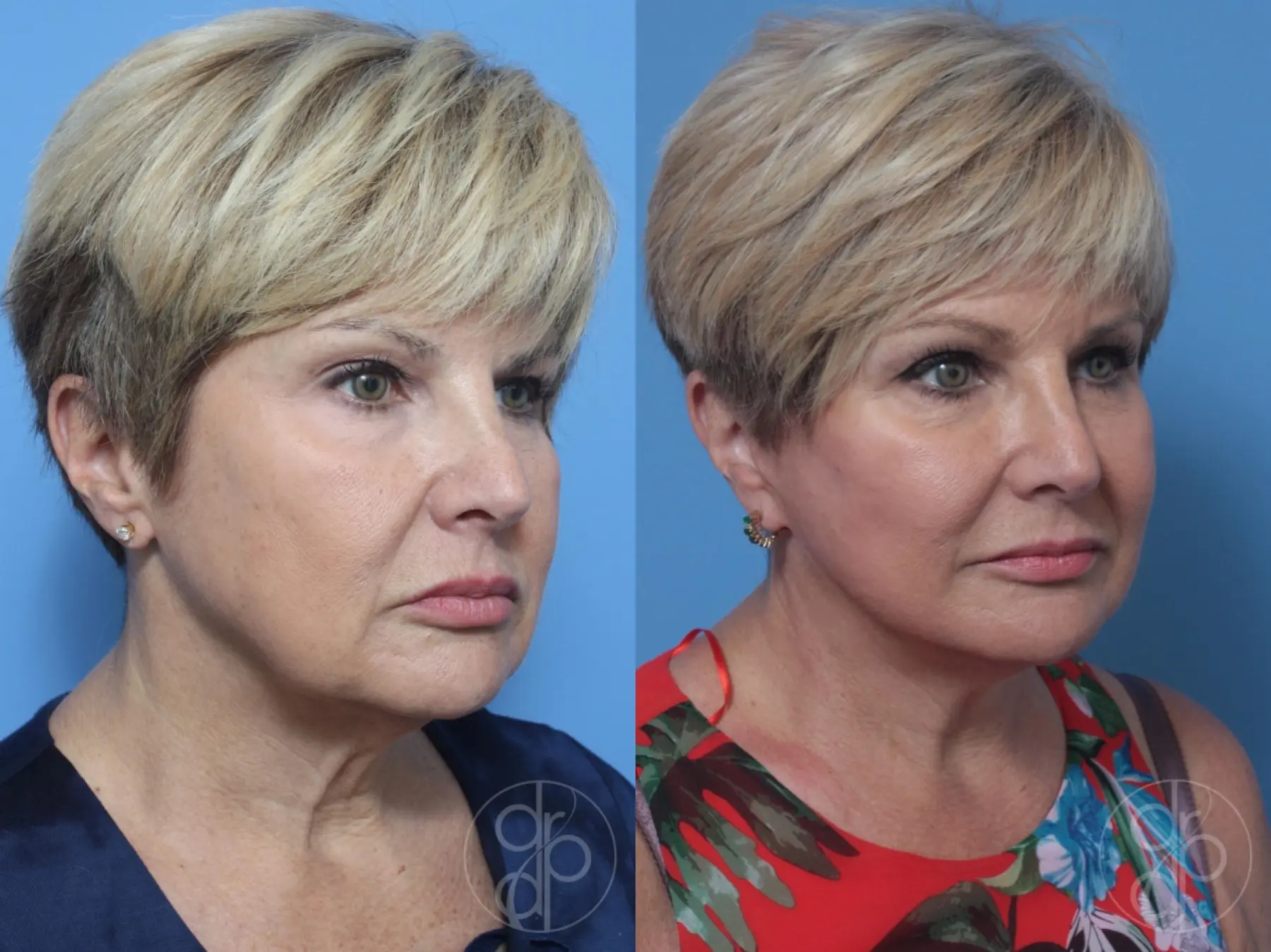 patient 10611 neck lift before and after result - Before and After 2