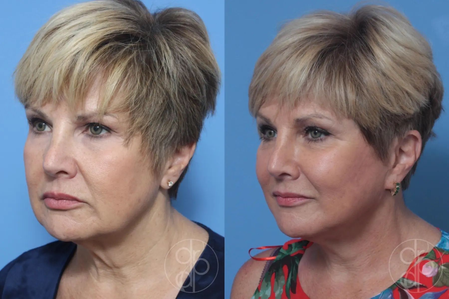 patient 10611 neck lift before and after result - Before and After 3