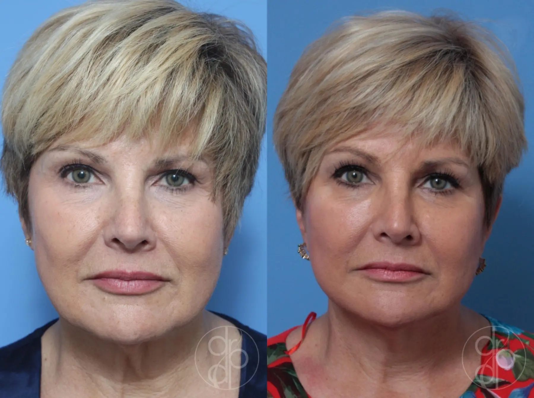 patient 10611 neck lift before and after result - Before and After
