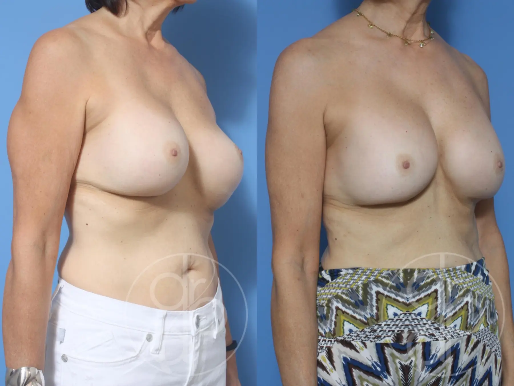 patient 12179 remove and replace breast implants before and after result - Before and After 2