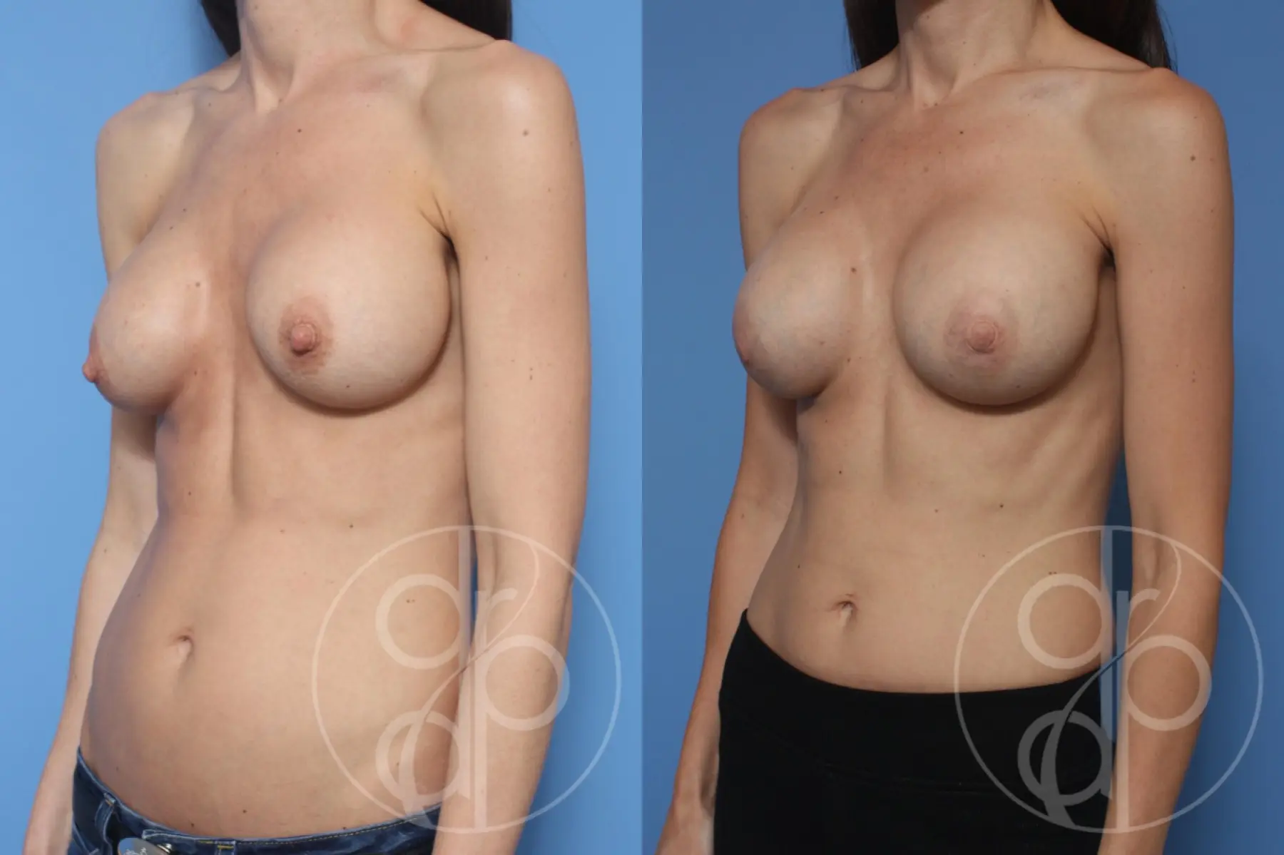 patient 10398 remove and replace breast implants before and after result - Before and After 2