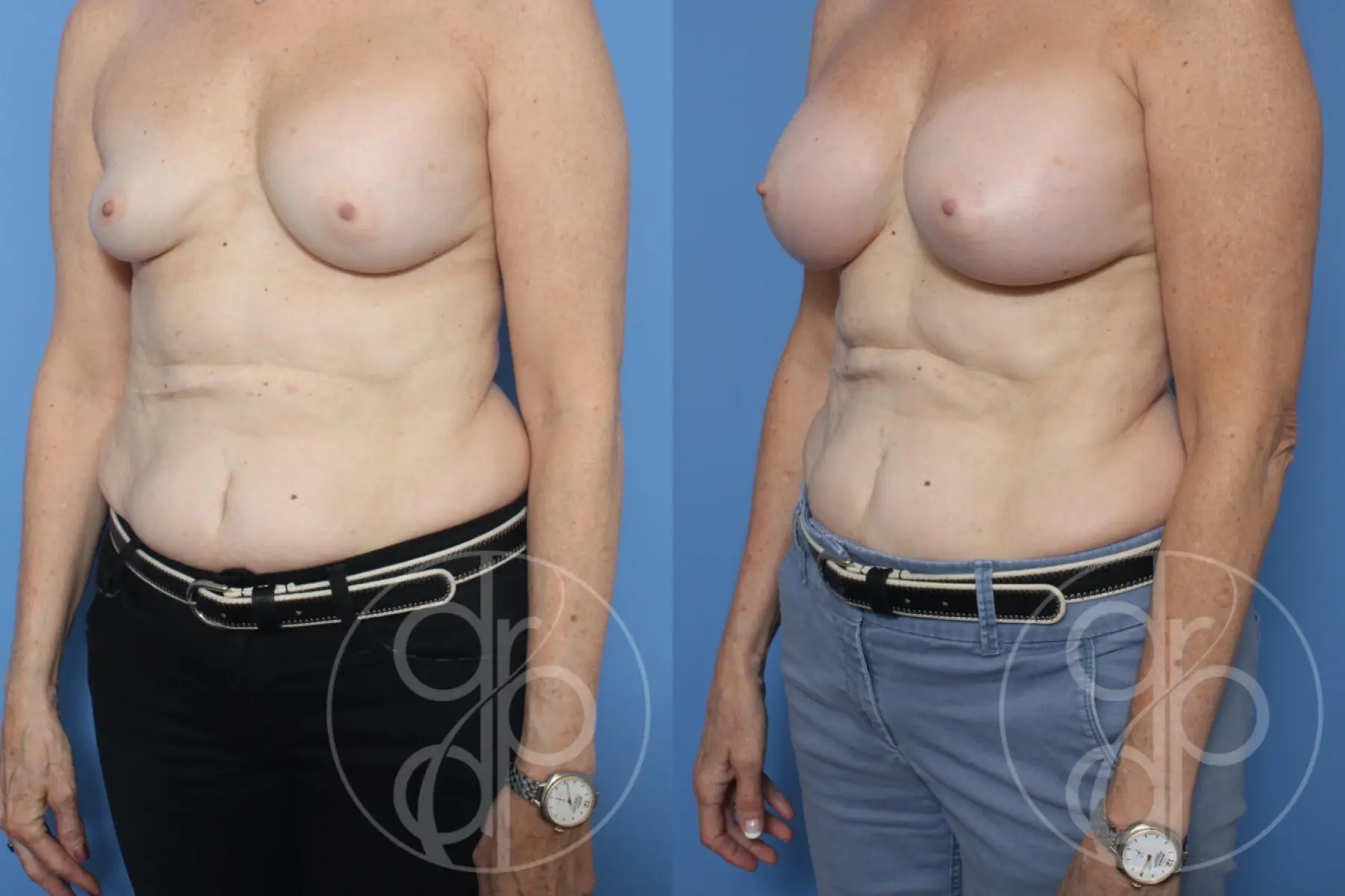 patient 12045 remove and replace breast implants before and after result - Before and After 3