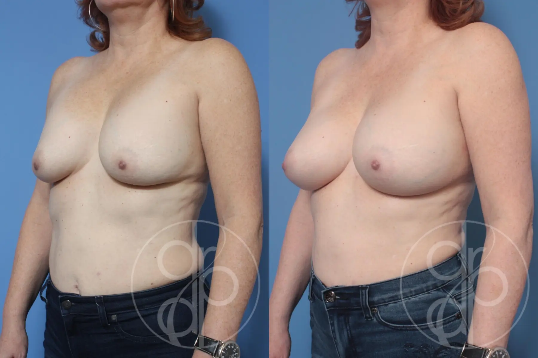 patient 10447 remove and replace breast implants before and after result - Before and After 2