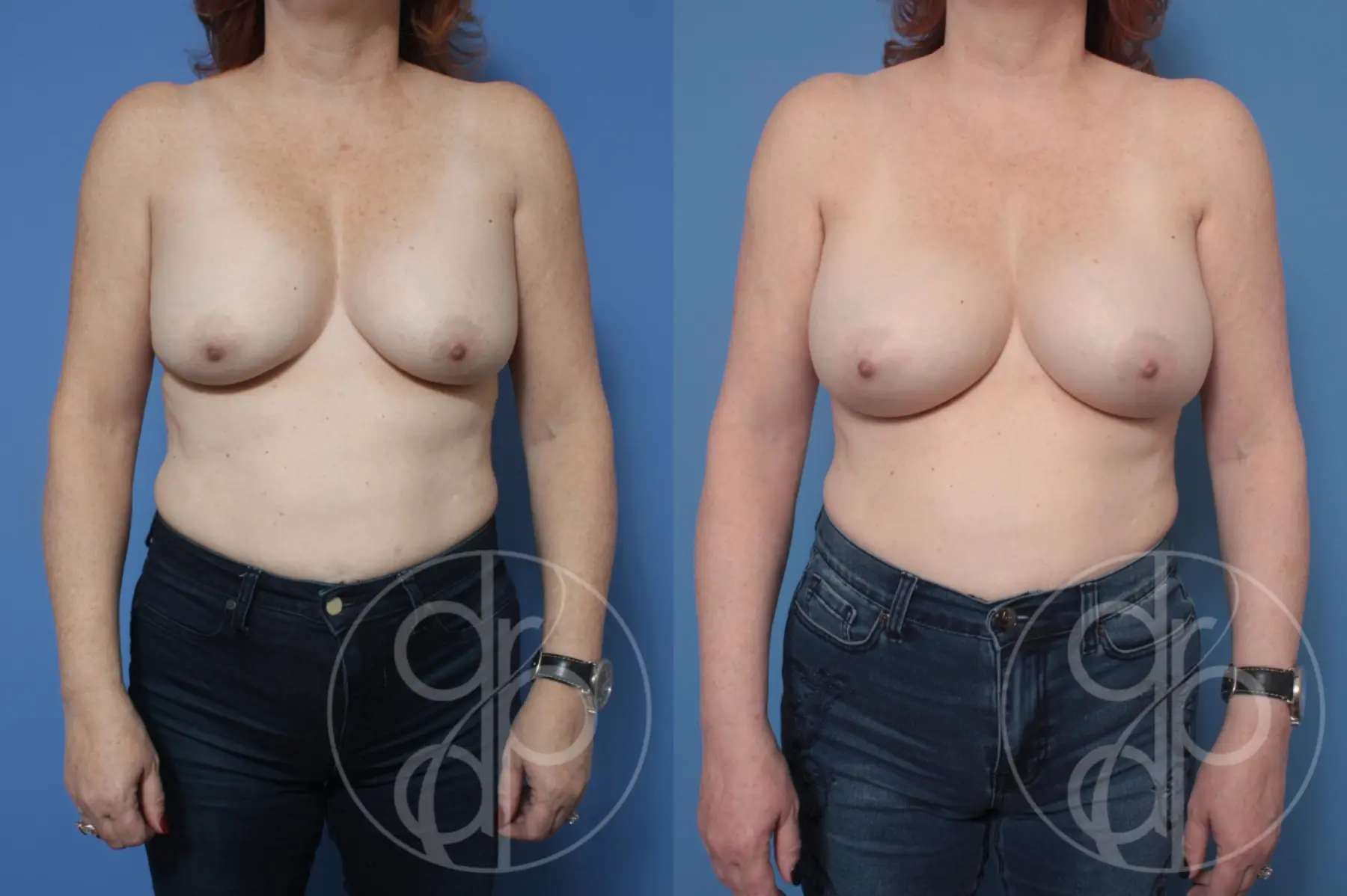 patient 10447 remove and replace breast implants before and after result - Before and After