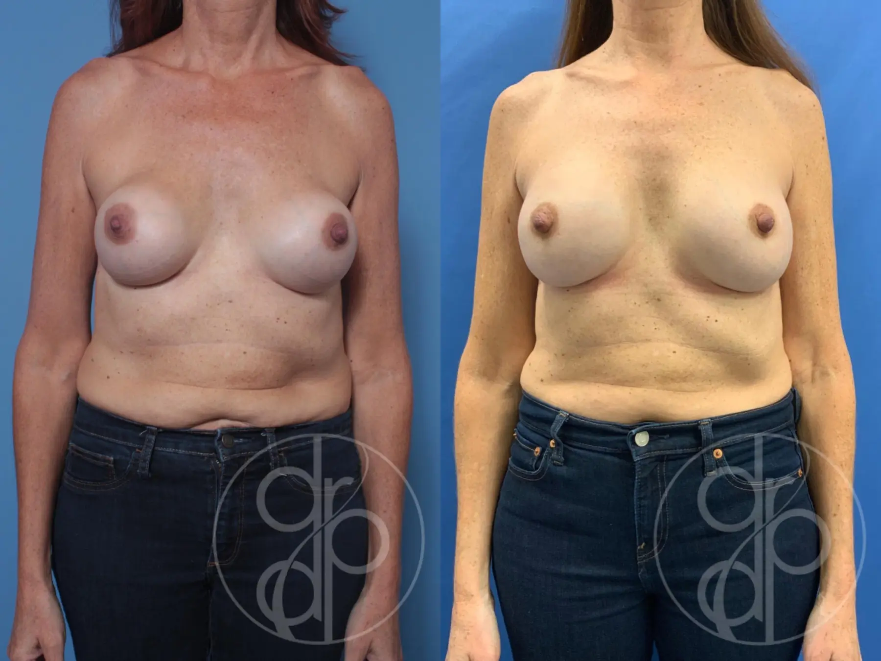 patient 10172 remove and replace breast implants before and after result - Before and After