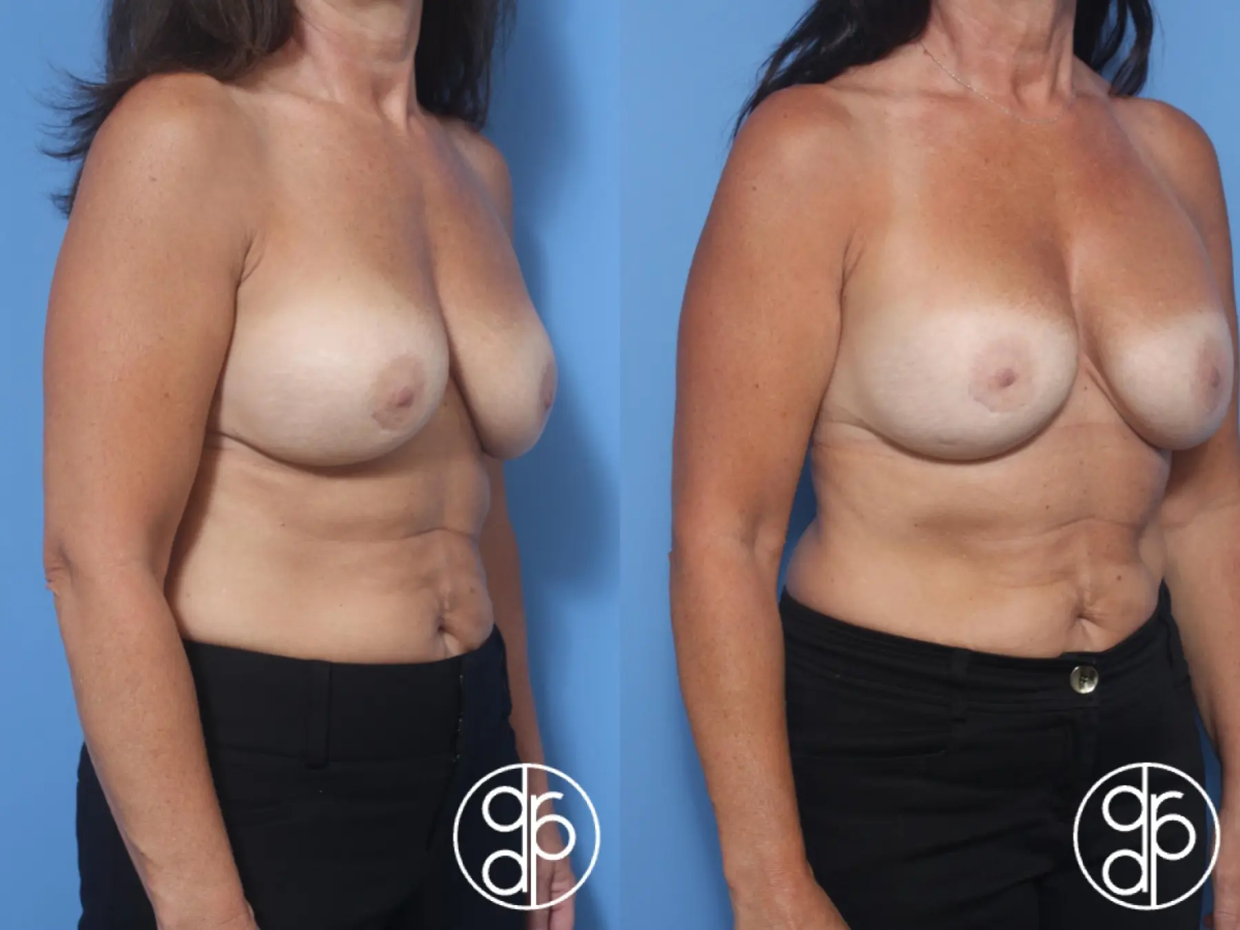 patient 11904 remove and replace breast implants before and after result - Before and After 2