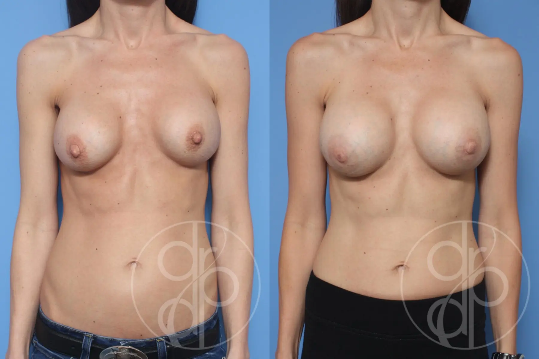 patient 10398 remove and replace breast implants before and after result - Before and After