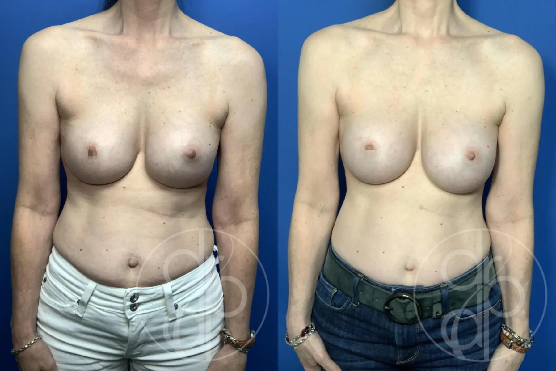 Patient 14230 remove and replace procedure before and after result - Before and After  