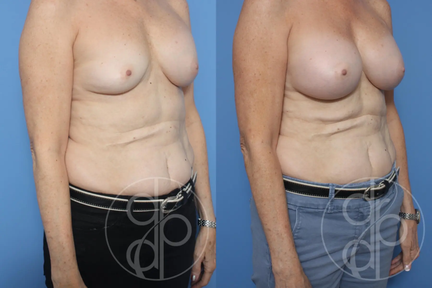 patient 12045 remove and replace breast implants before and after result - Before and After 2