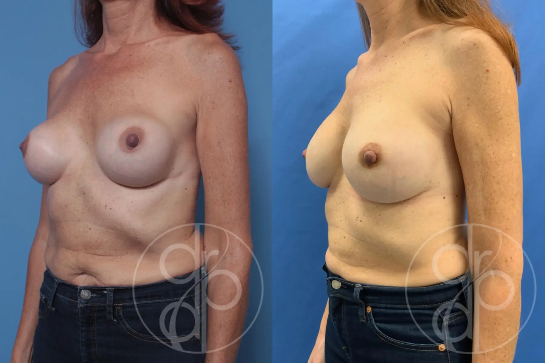 patient 10172 remove and replace breast implants before and after result - Before and After 3