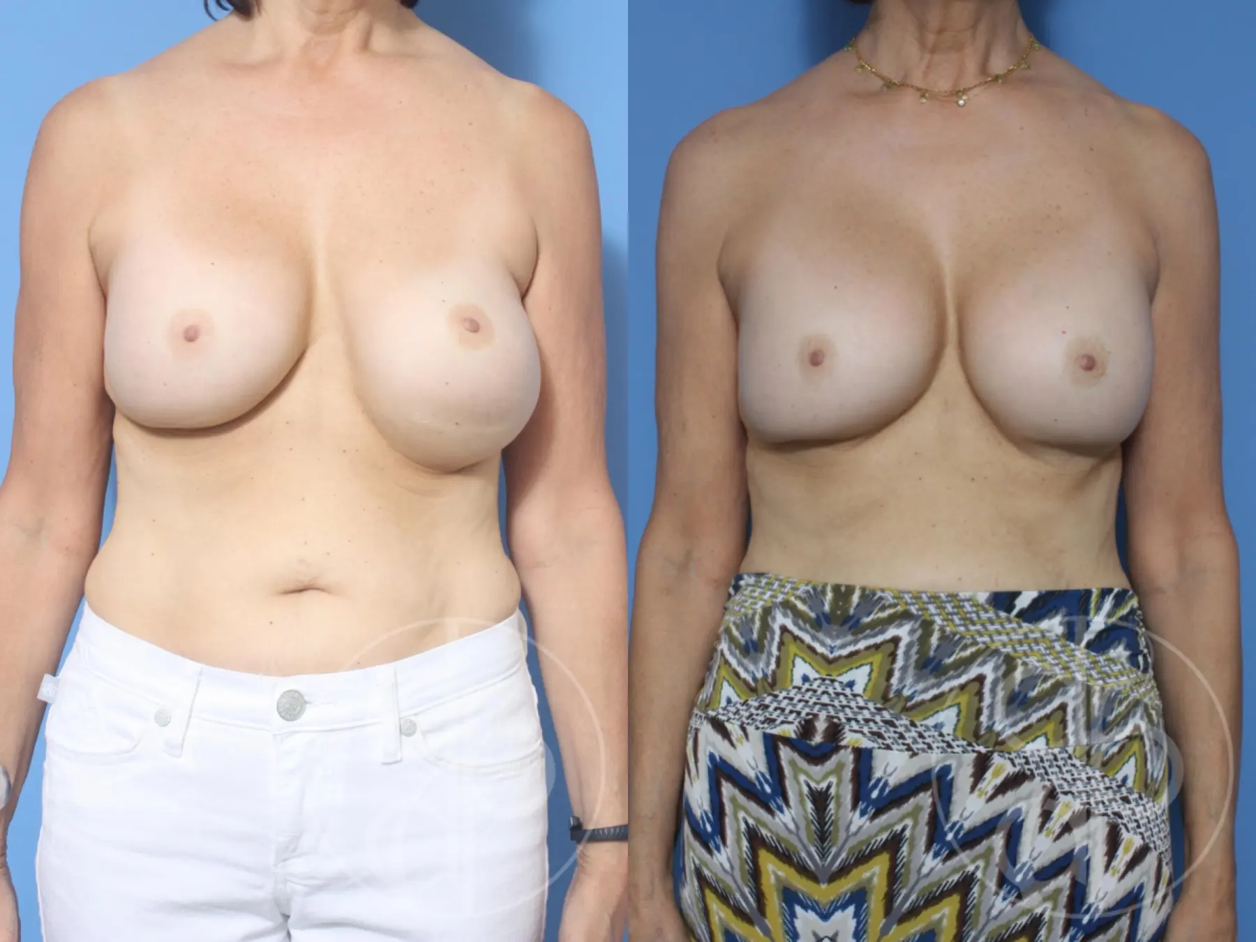 patient 12179 remove and replace breast implants before and after result - Before and After 1