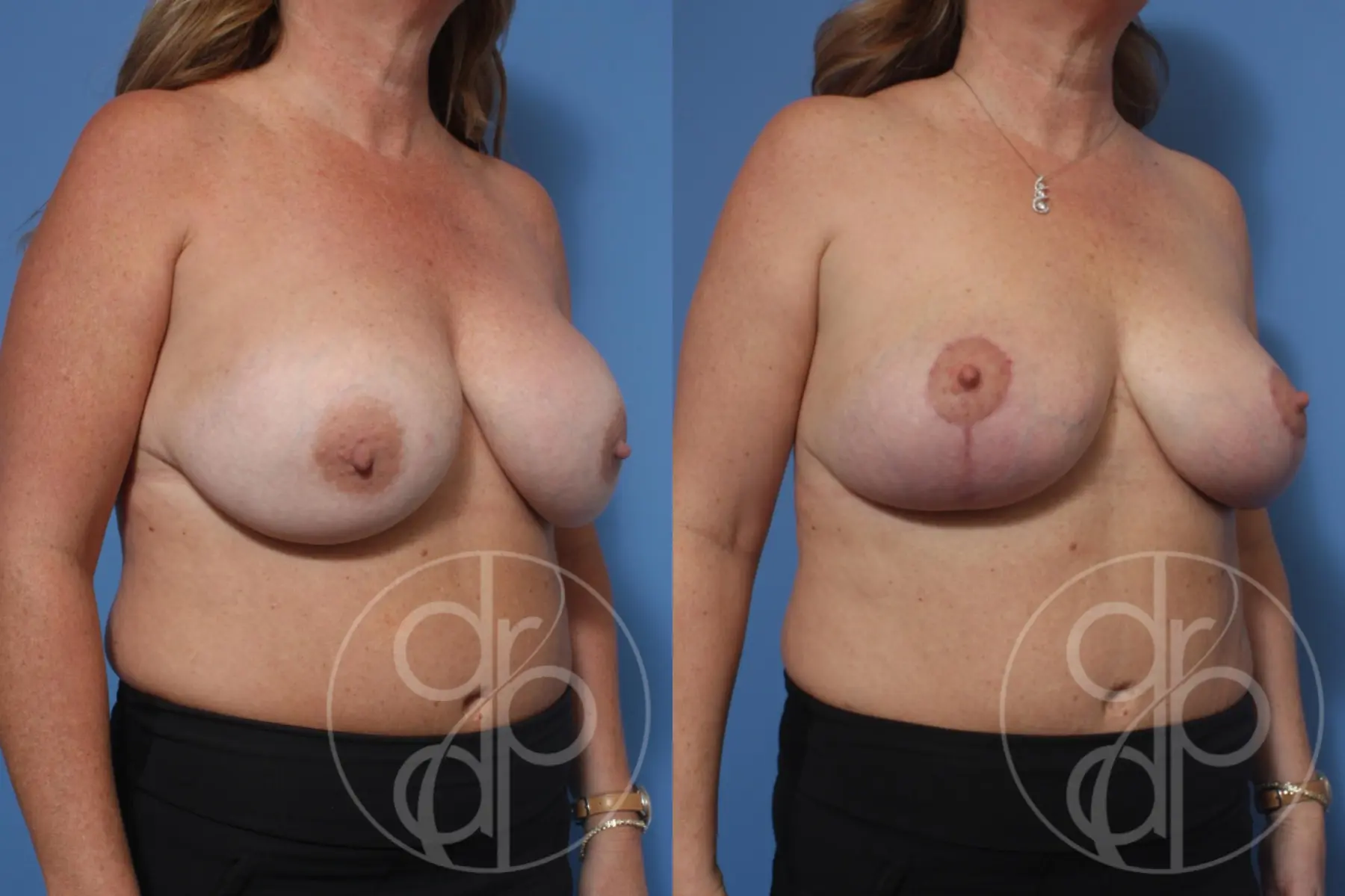 patient 10492 remove and replace breast implants before and after result - Before and After 2