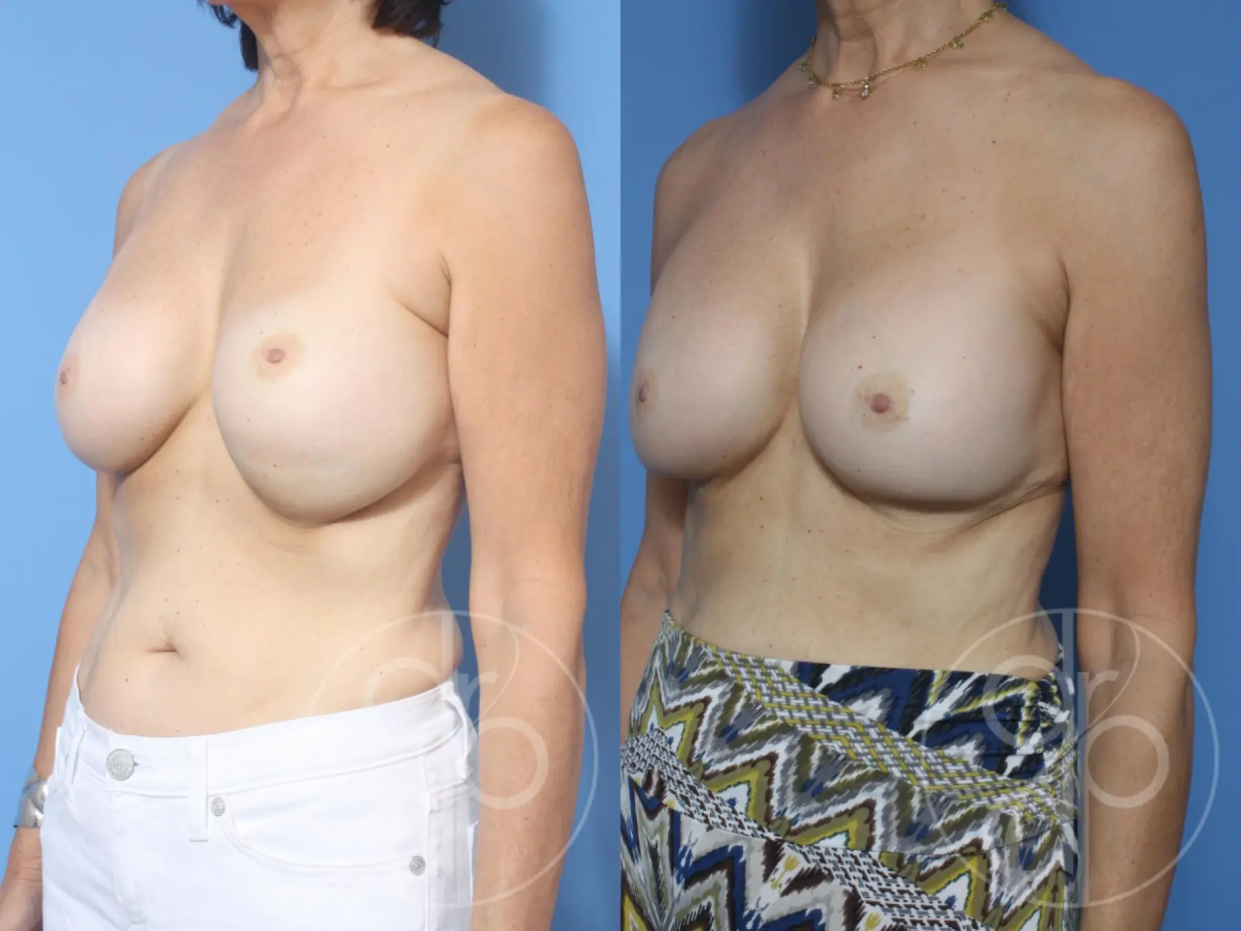 patient 12179 remove and replace breast implants before and after result - Before and After 3