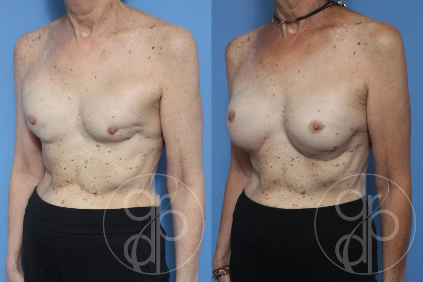 patient 10541 remove and replace breast implants before and after result - Before and After 3