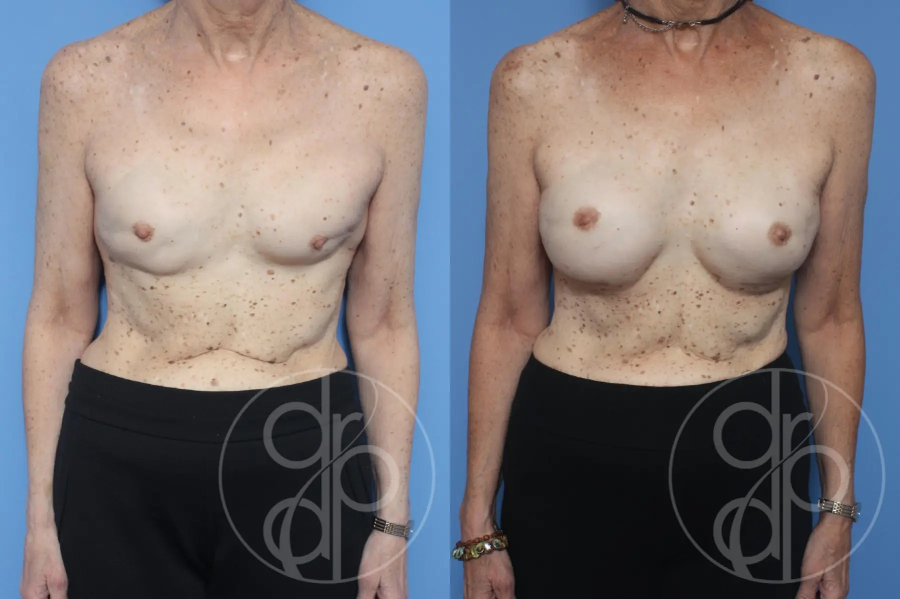 patient 10541 remove and replace breast implants before and after result - Before and After 1