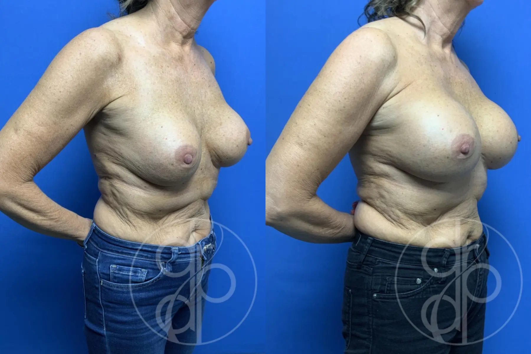 patient 13732 remove and replace breast implants before and after result - Before and After 2