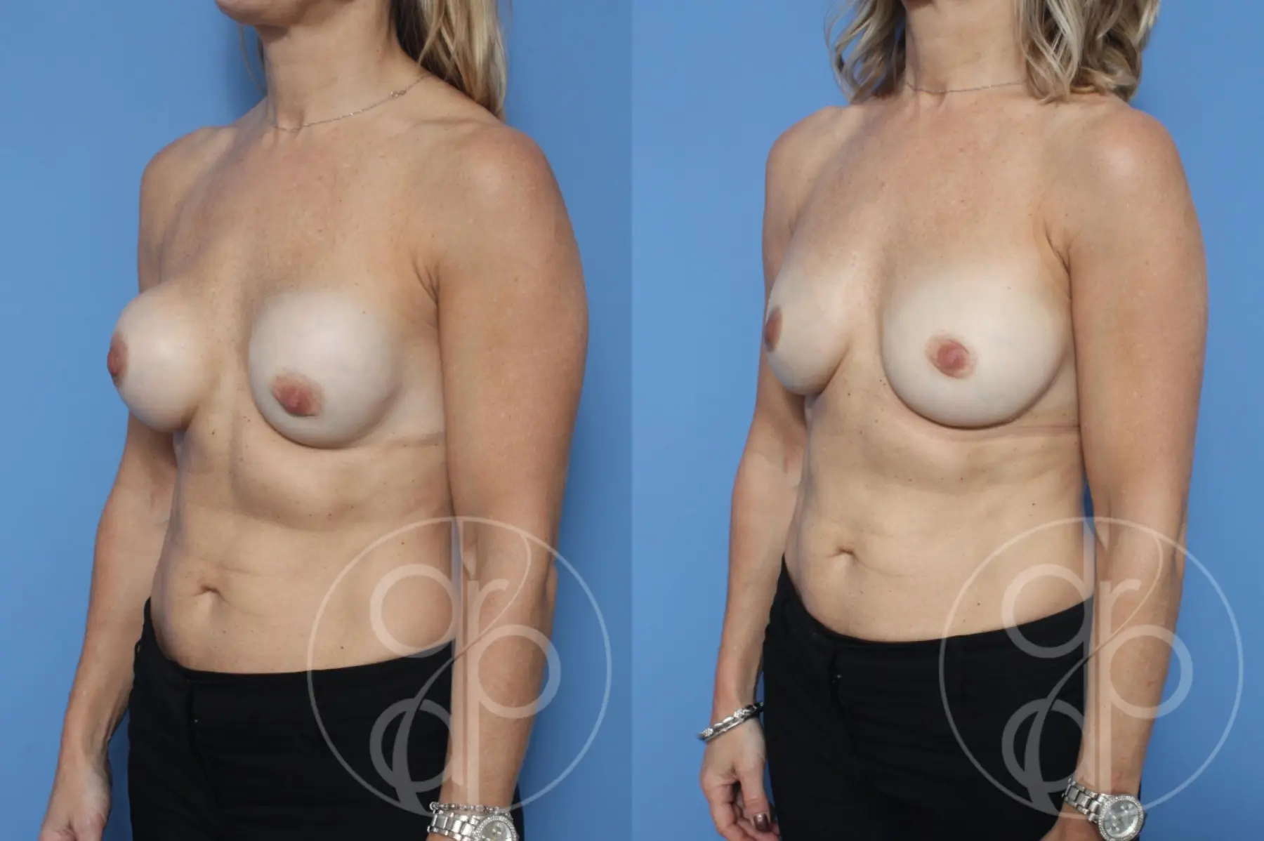 patient 10500 remove and replace breast implants before and after result - Before and After 3