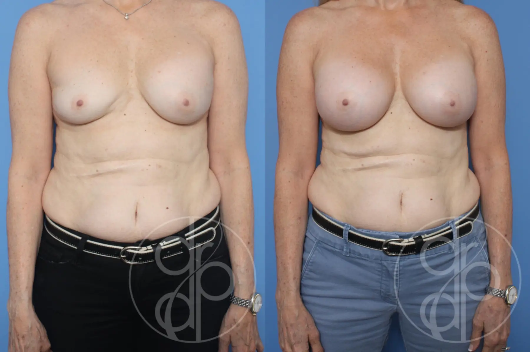 patient 12045 remove and replace breast implants before and after result - Before and After 1