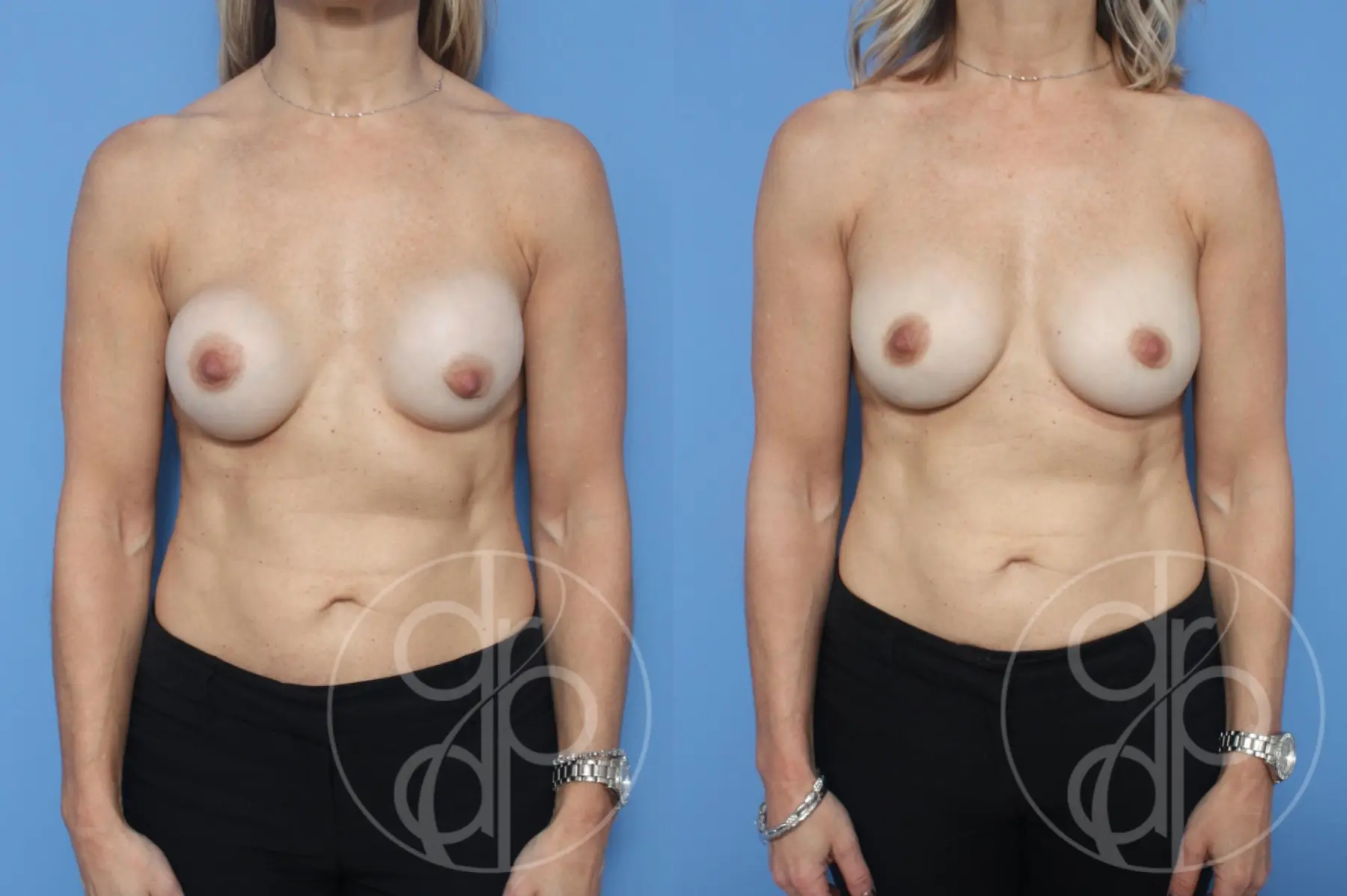 patient 10500 remove and replace breast implants before and after result - Before and After