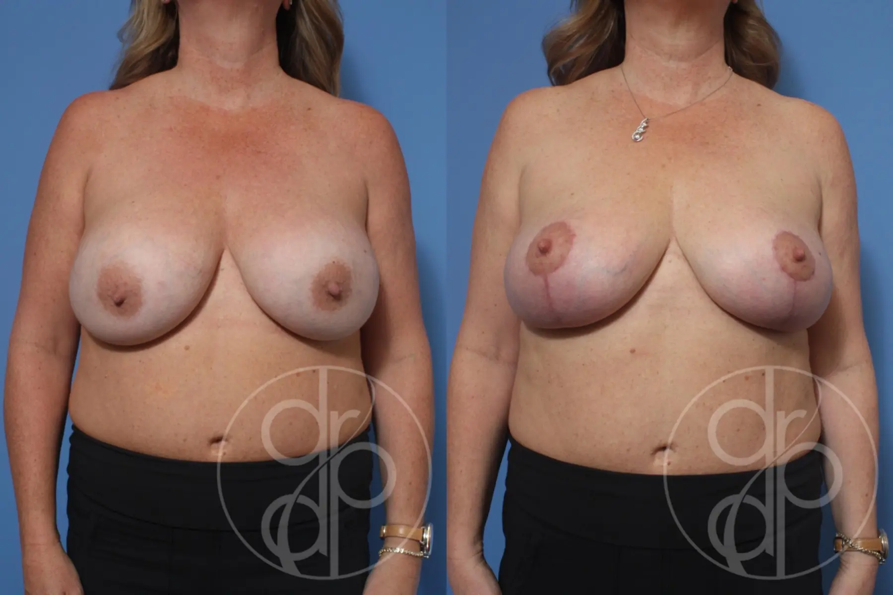 patient 10492 remove and replace breast implants before and after result - Before and After 1
