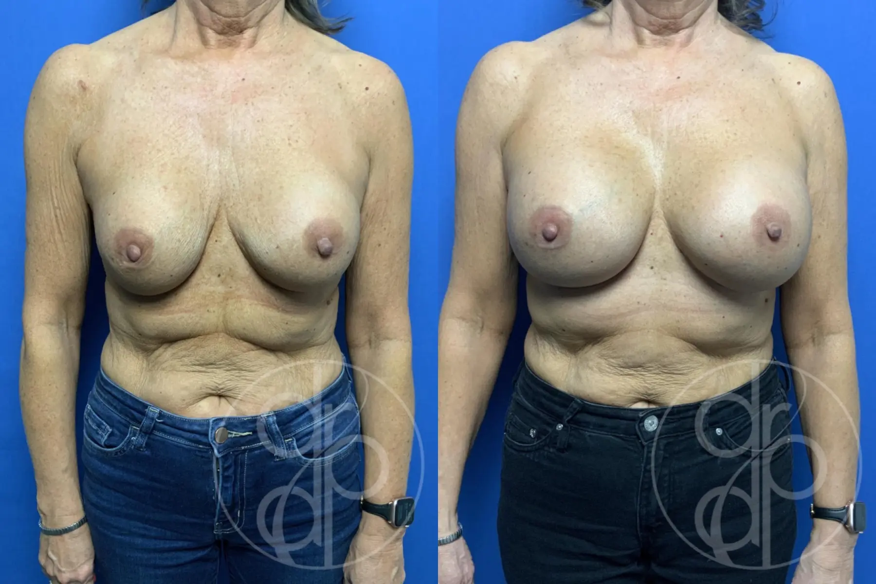 patient 13732 remove and replace breast implants before and after result - Before and After 1