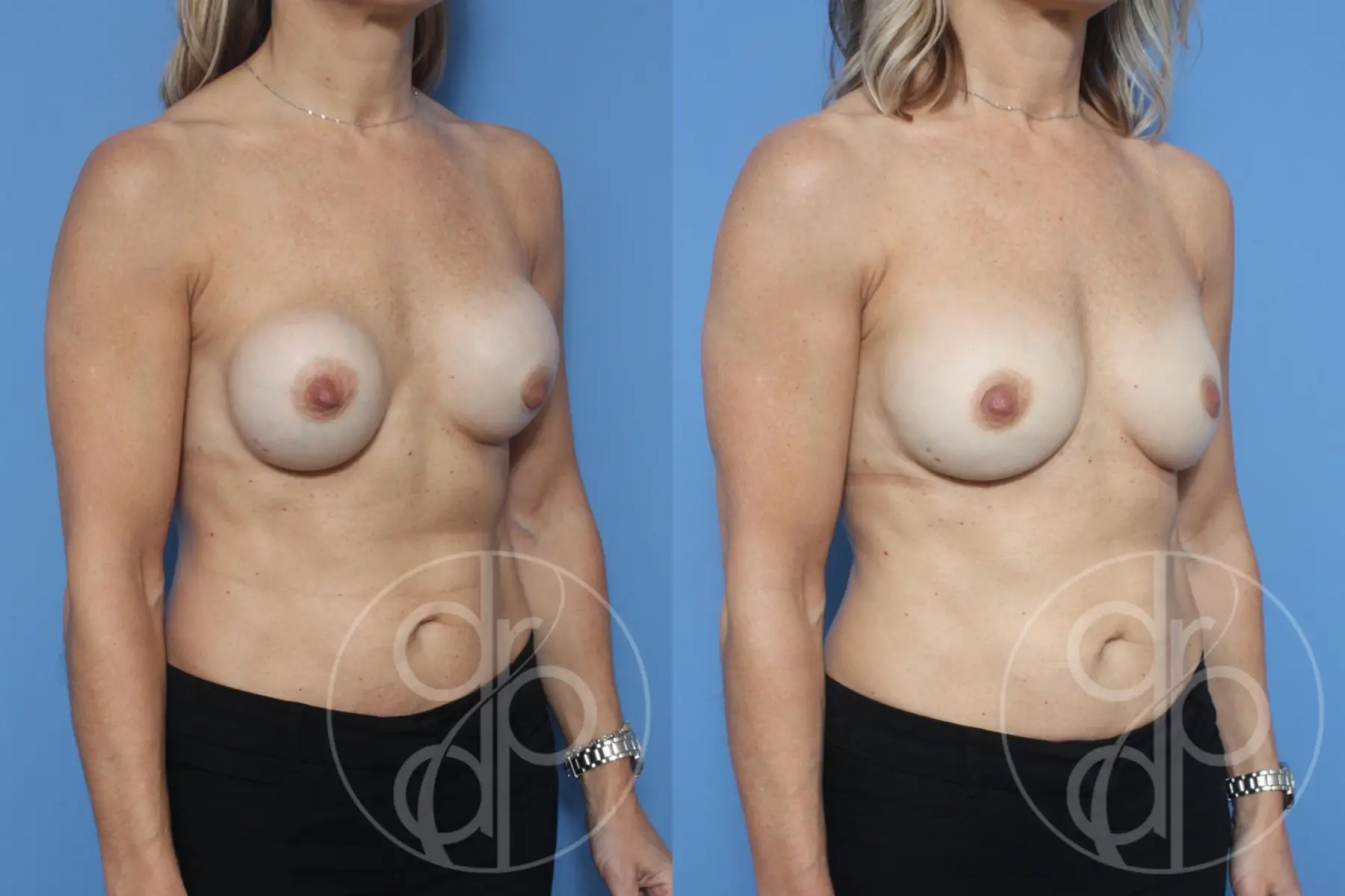 patient 10500 remove and replace breast implants before and after result - Before and After 2