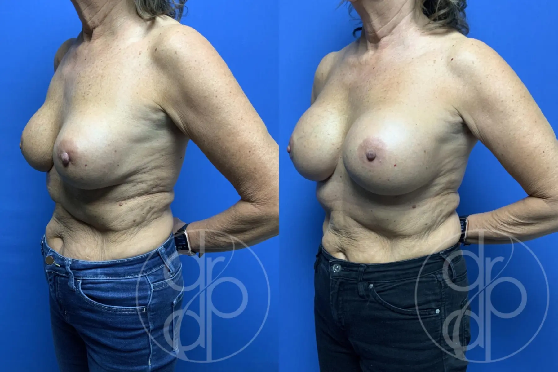patient 13732 remove and replace breast implants before and after result - Before and After 3