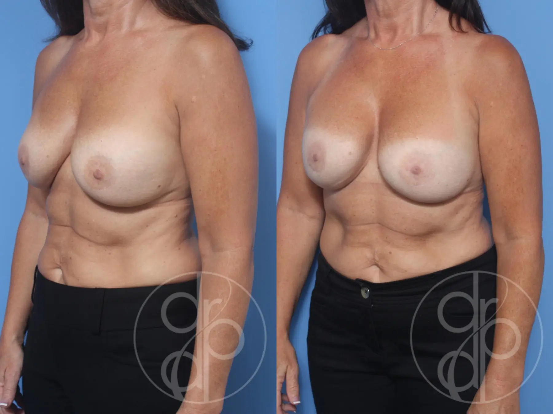 patient 11904 remove and replace breast implants before and after result - Before and After 3