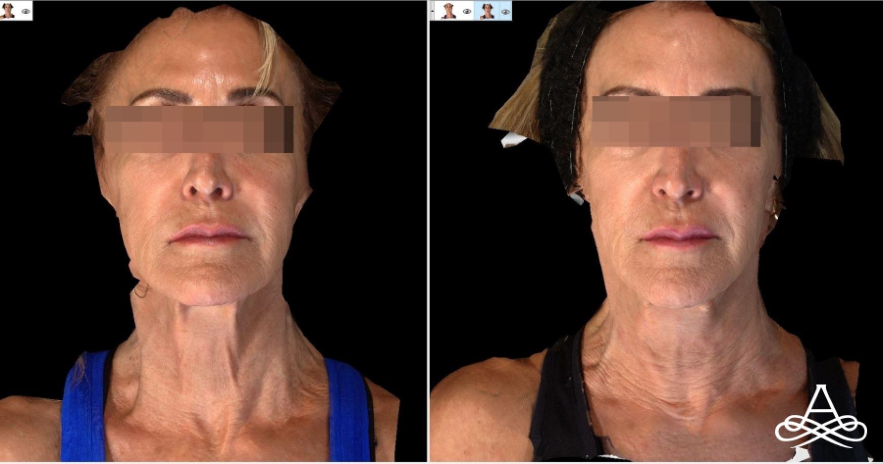 Bellafill®: Patient 10 - Before and After  